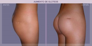 Before and after image of a butt augmentation procedure.